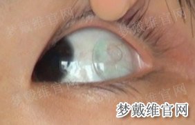 角膜塑形镜偏到白眼球上怎么办？
